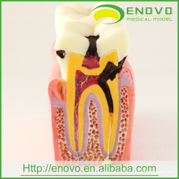 Modèle de dents pathologiques dentaires EN-M2 de 6Ttimes Caries Comparation